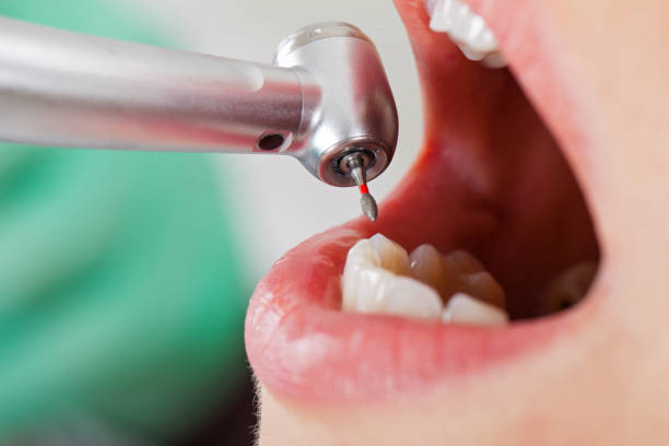 Best Root Canal Emergency Dentist  in Vineyard, CA